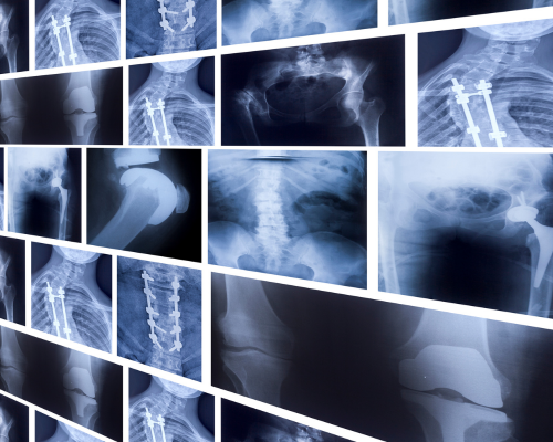 Digital X-Ray